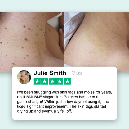 🔥LAST DAY 80% OFF - LBMLBM® Magnesium Micro-pin Wart Removal Patch