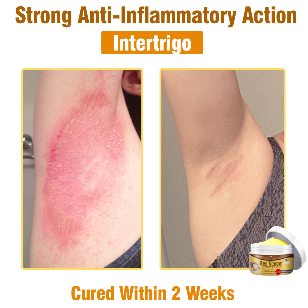 🐝 flysmus® Bee Venom Comprehensive Cream