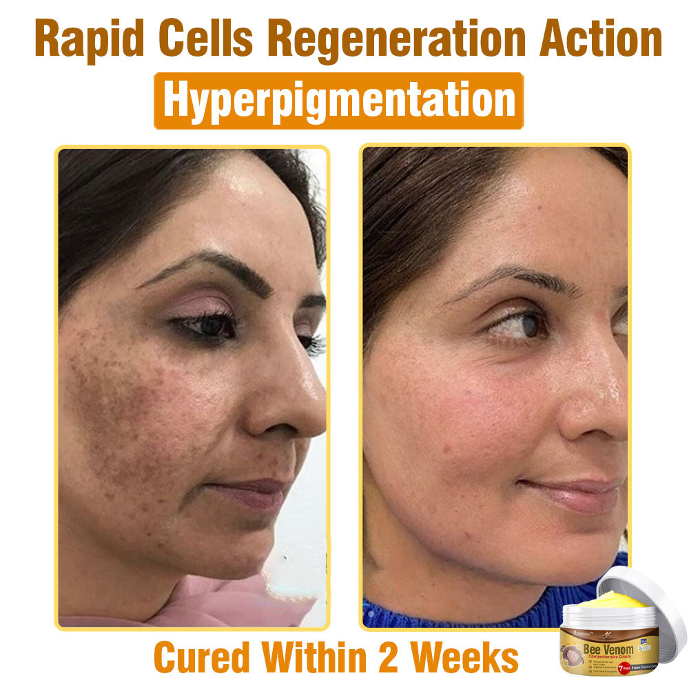 🐝 flysmus® Bee Venom Comprehensive Cream