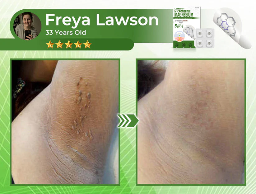 🔥Final 3 Hours: 80% OFF - LBMLBM® Magnesium MicroNeedle Precise Remove Skin Tag Patches