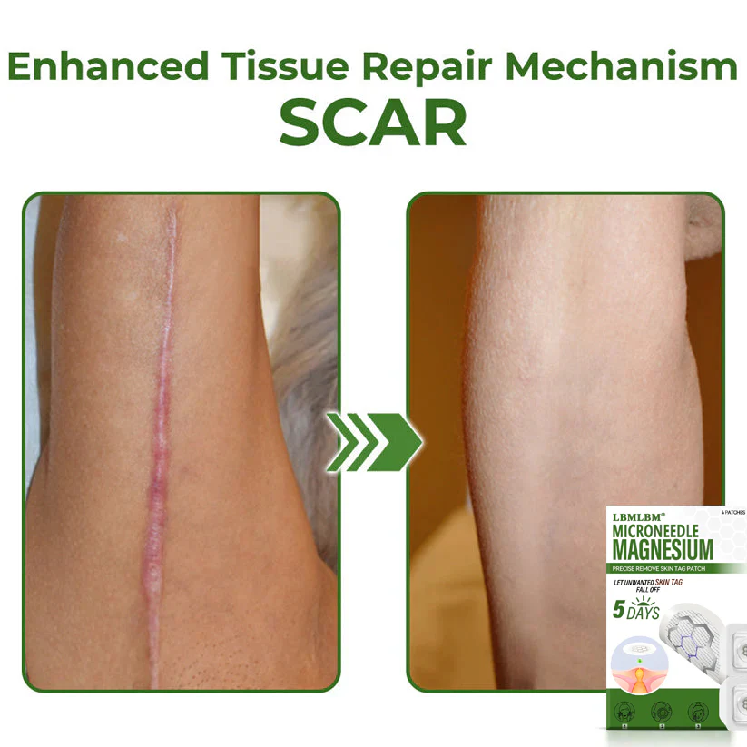 🔥Final 3 Hours: 80% OFF - LBMLBM® Magnesium MicroNeedle Precise Remove Skin Tag Patches