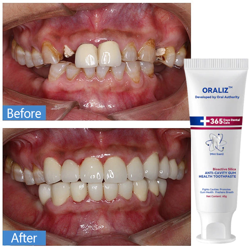 Oraliz™ Repair Teeth Anti-Decay - Hydroxyapatite Toothpaste