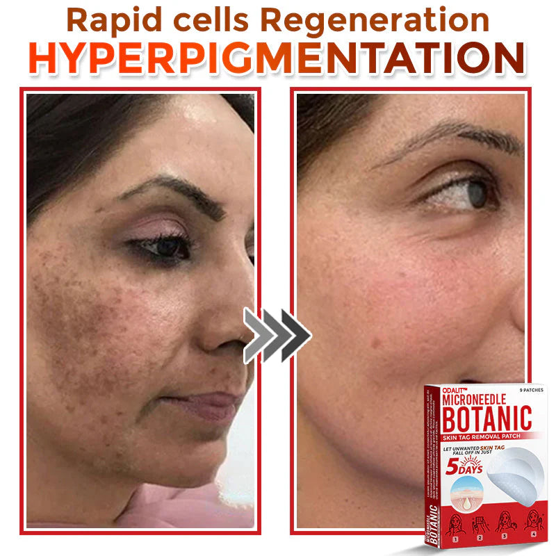 🌈ODALIT™ MicroNeedle Botanic Skin Tag Removal Patch 🇺🇸 Made in the USA