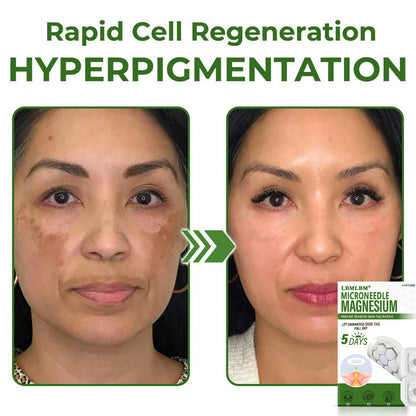 🔥Final 3 Hours: 80% OFF - LBMLBM® Magnesium MicroNeedle Precise Remove Skin Tag Patches