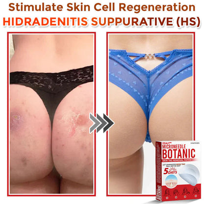 🌈ODALIT™ MicroNeedle Botanic Skin Tag Removal Patch 🇺🇸 Made in the USA